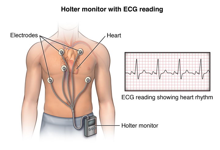 Holter 24 Horas: O que é? Como se realiza? Para que serve?