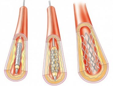 Implante de Stents