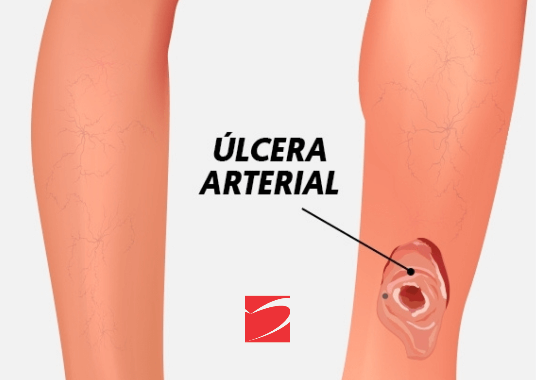 ÚLCERAS ARTERIAIS