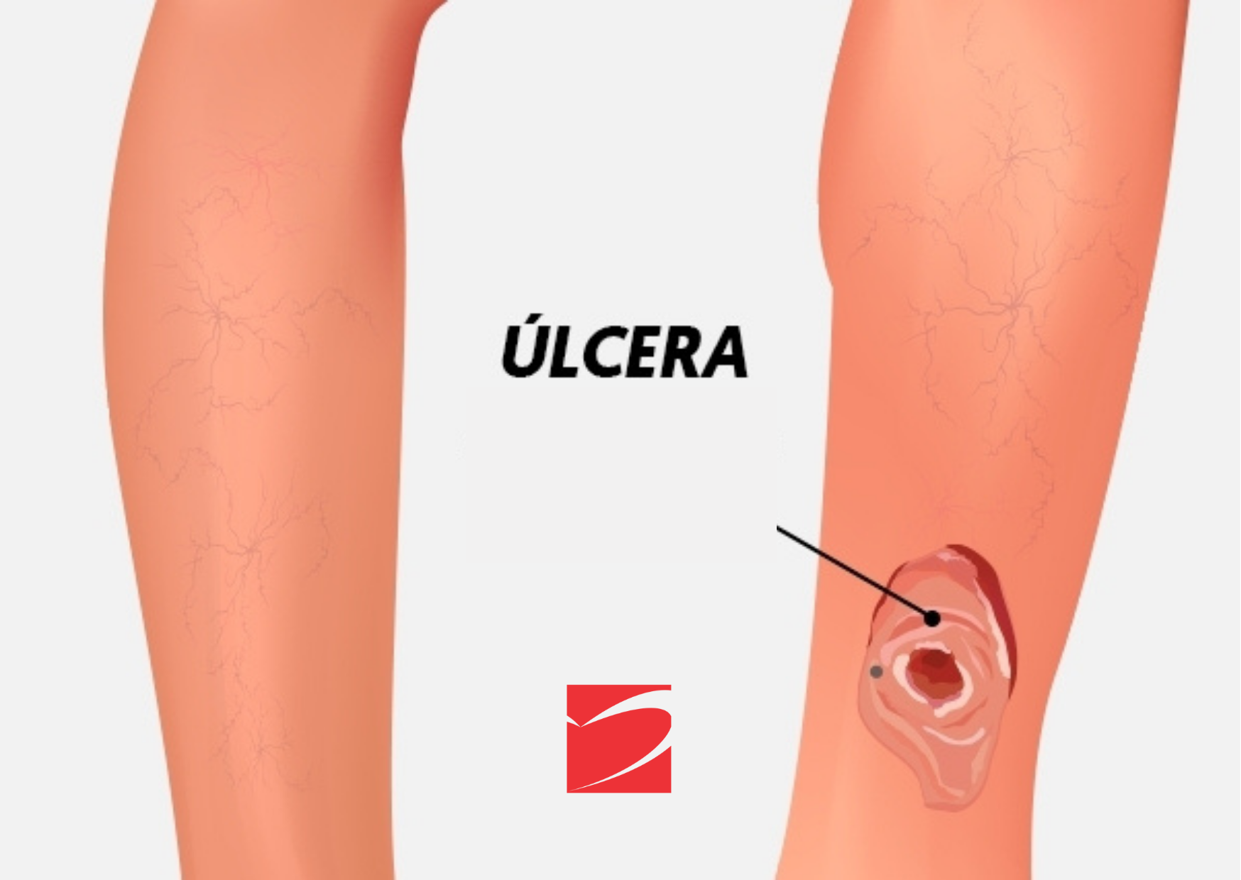 Úlceras varicosas