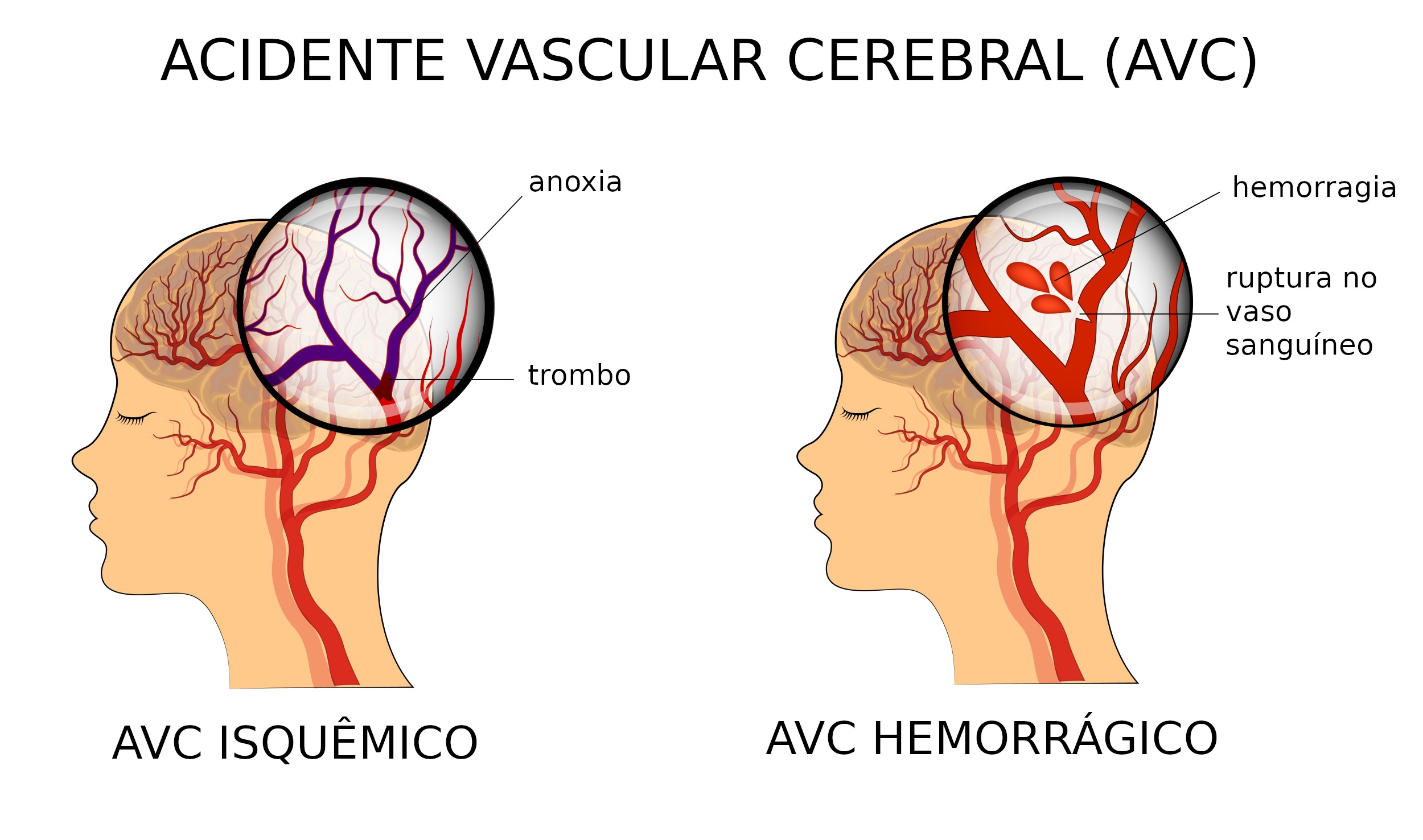 Acidente Vascular Cerebral